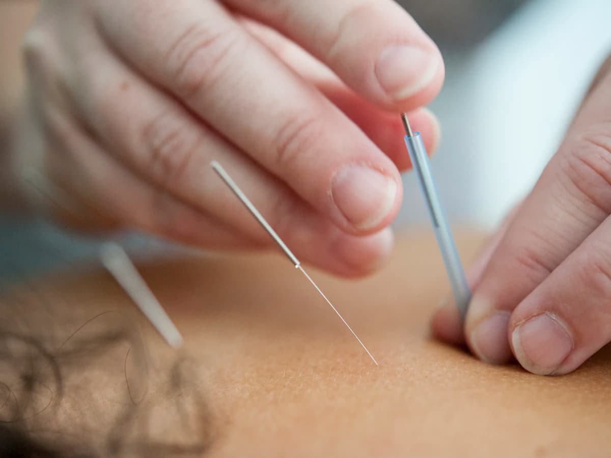 Agujas de acupuntura sobre la piel durante una sesión